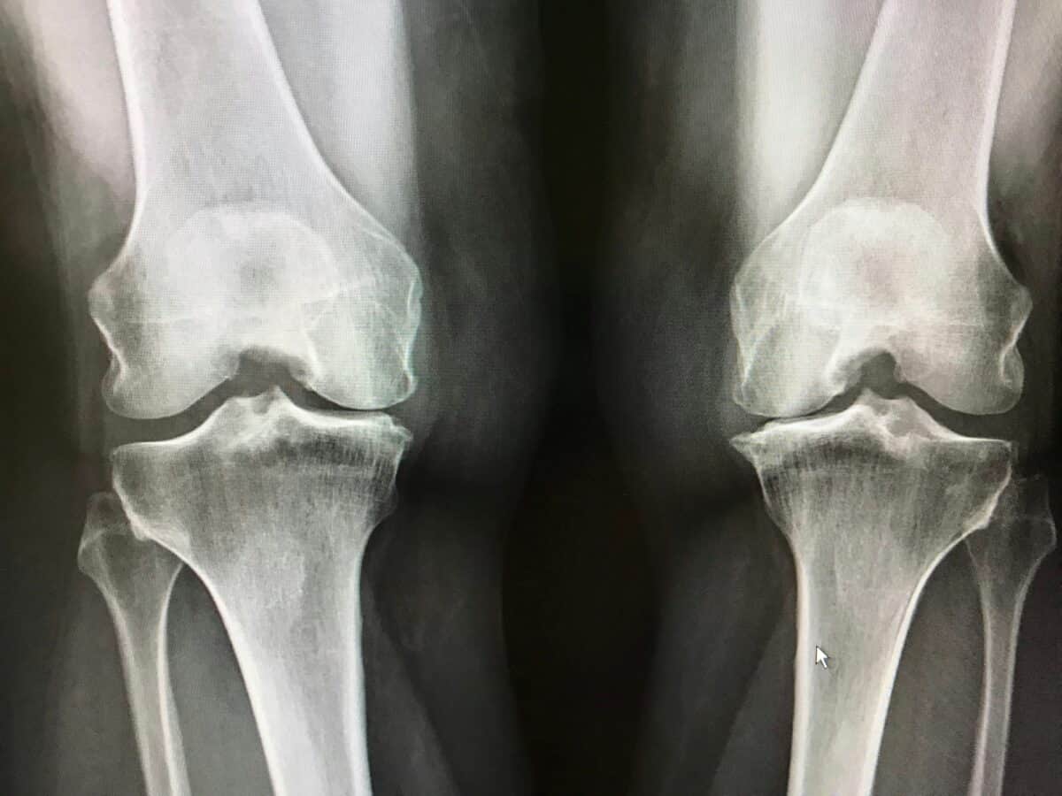 La radiographie montre un rétrécissement des os du genou, une perte de cartilage, des éperons et des callosités dus à l'arthrose.